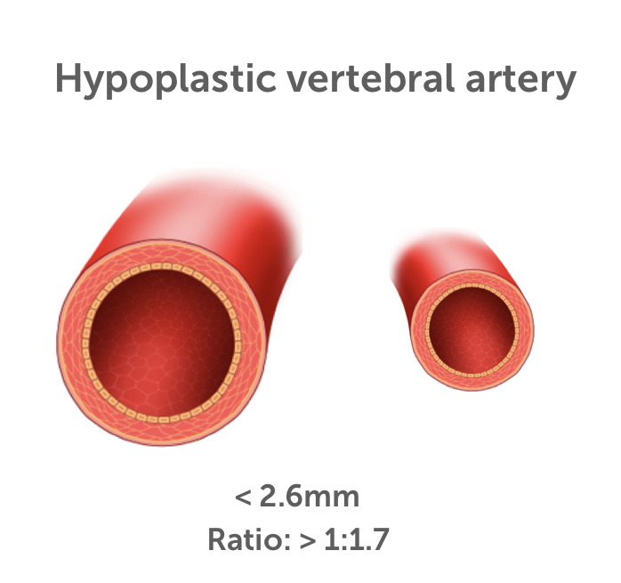 13 Vertebral Artery Pathologies 123 Sonography